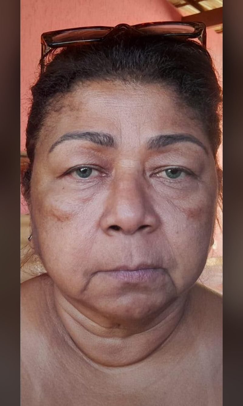 Depois: resultado de estética facial