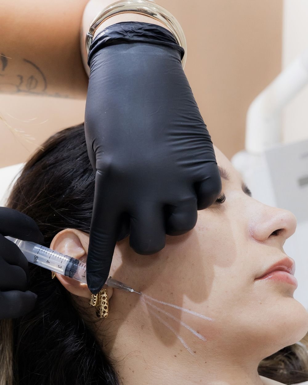 Aplicação de bioestimulador de colágeno no rosto de uma paciente